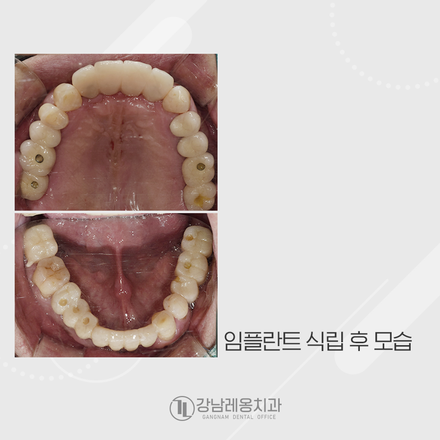강남레옹치과 전악 임플란트 수술로 심미, 저작 기능을 회복해요. 관련 이미지 5