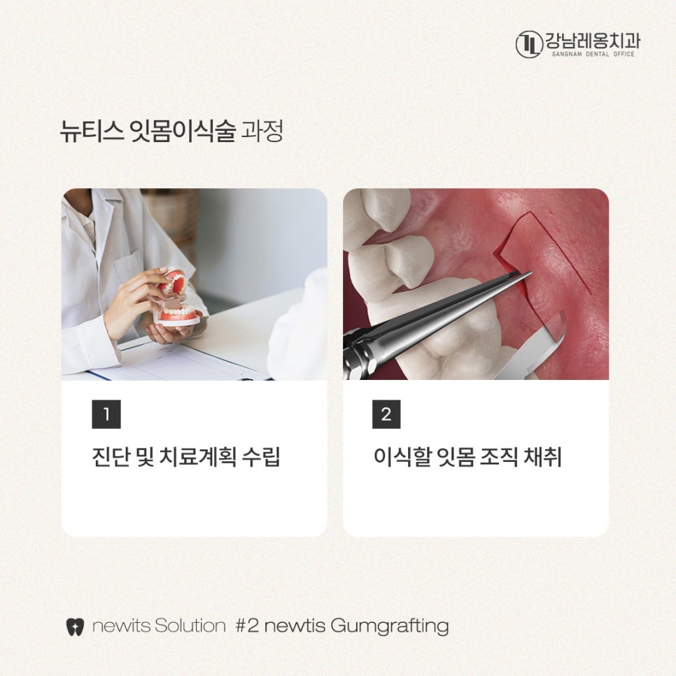 뉴티스 잇몸이식✨ 잇몸퇴축, 치아뿌리를 보호하고 심미적 개선 / 강남레옹치과 관련 이미지 3