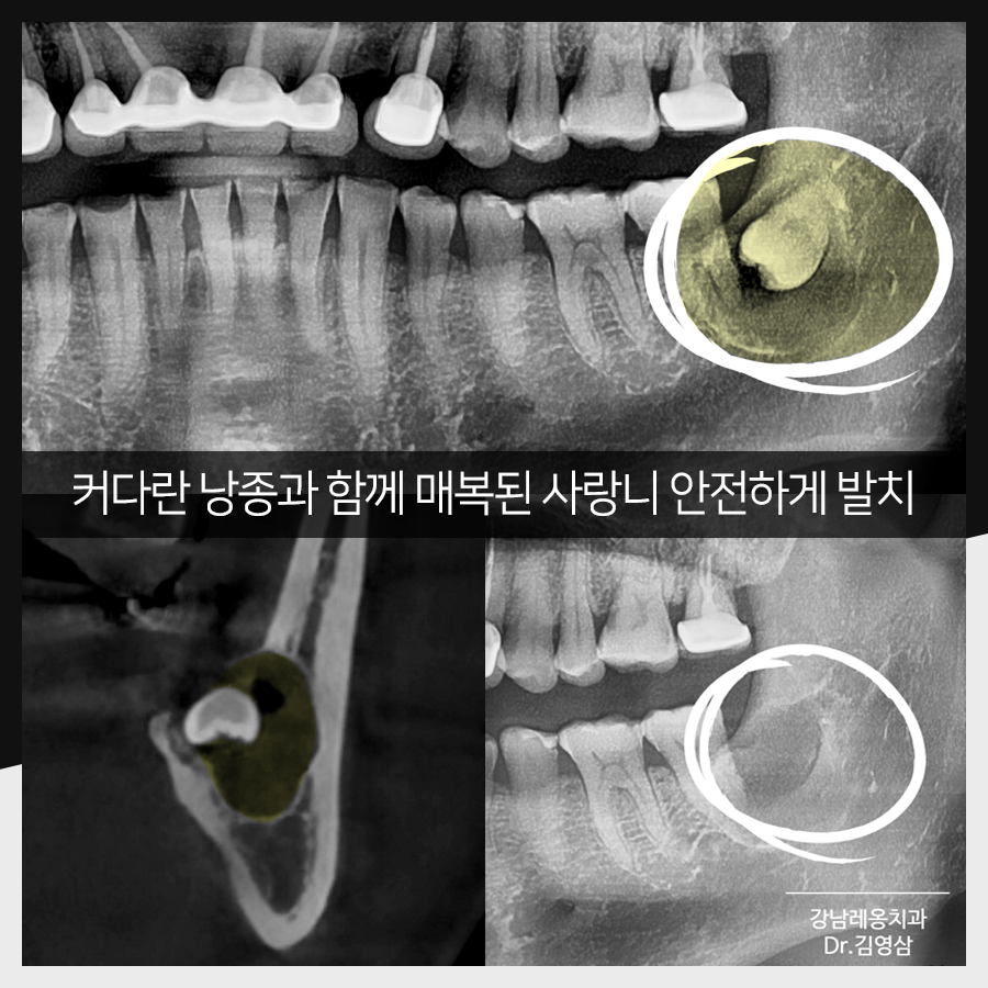 강남레옹치과 사랑니 발치, 결과가 증명해주는 실력! 관련 이미지 22