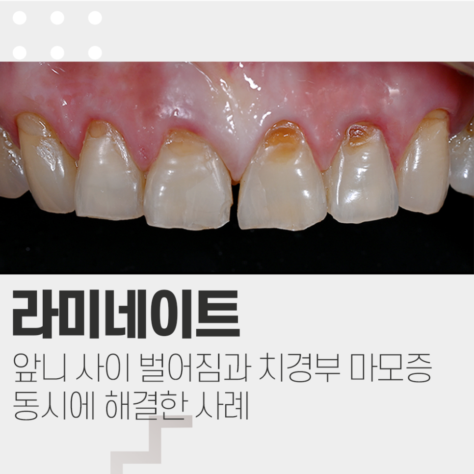 치경부마모증 때문에 시린이 레진 후 라미네이트 관련 이미지 1