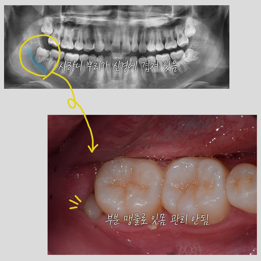 사랑니 발치 전문 레옹의 치료사례, 신경이 가깝거나 멀거나 관련 이미지 2