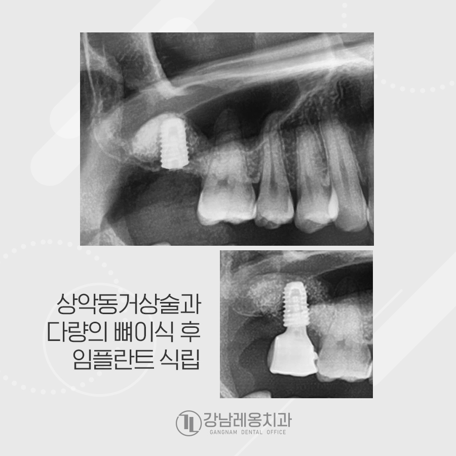 뼈가 얇아 상악동거상술과 뼈이식 후 임플란트 관련 이미지 3
