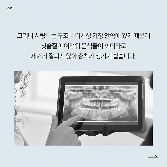 사랑니 4개 다 꼭 뽑아야 될까요? 발치 달인 강남레옹치과의 답변~ 관련 이미지 4