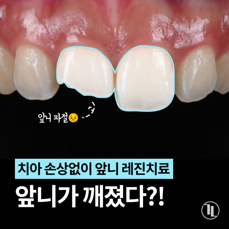 치아 손상없이 앞니 레진치료, 실제 후기 3가지! / 강남레옹치과 관련 이미지 1