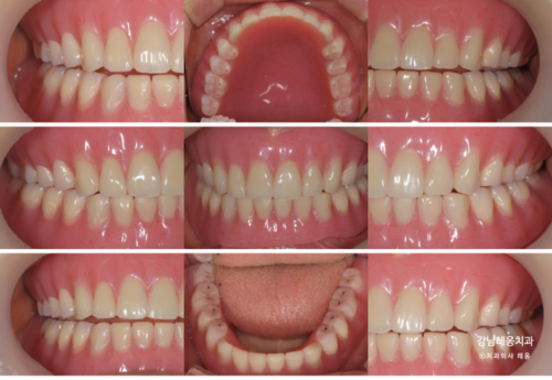 만 65세 이상 틀니 보험적용 혜택과 과정💫 / 보훈위탁병원 강남레옹치과 관련 이미지 7