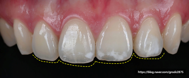 앞니에 하얀얼룩이? 앞니 길이가 달라요! / 앞니통합치료 뉴티스 반점치료 + 치아성형✨ / 강남레옹치과 관련 이미지 10