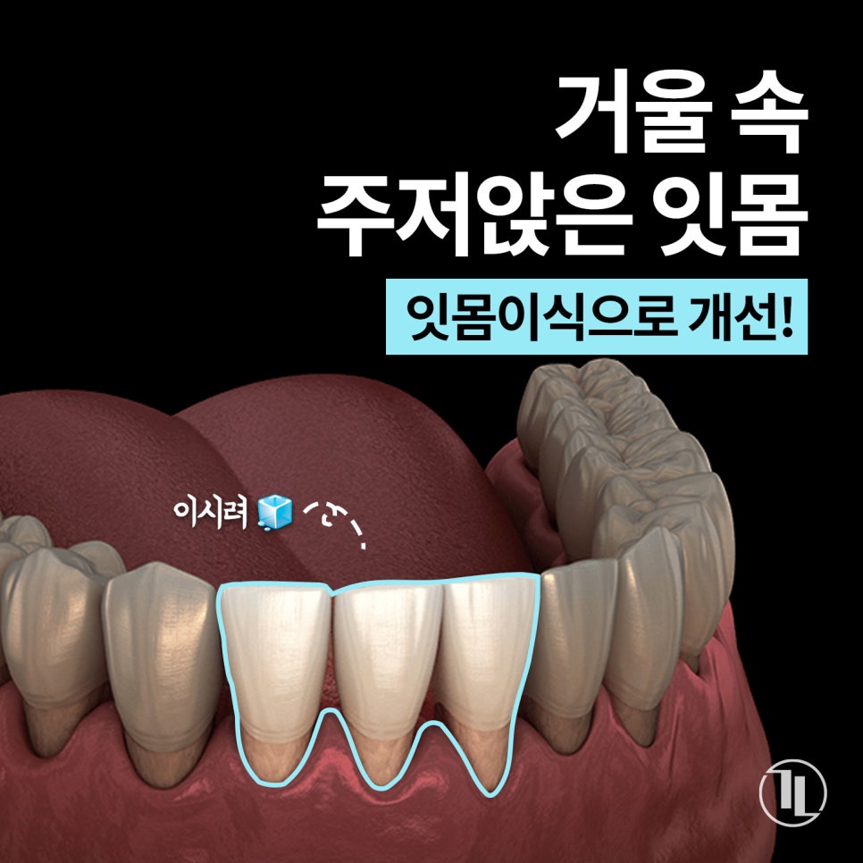 Gum Recession: Can It Expose the Tooth Roots? Before and After Gum Grafting! / Gangnam Leon Dental Clinic image 1