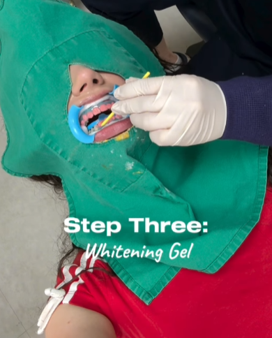 강남레옹치과 뉴티스 치아미백 Vlog📽️ | 치아미백 효과, 유지기간, 부작용 총정리! 관련 이미지 9