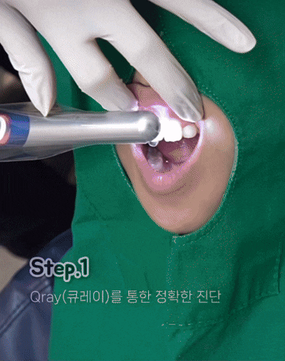 우리 아이 앞니에 하얀 반점! 소아 충치 시작의 신호? / 강남레옹치과 관련 이미지 4