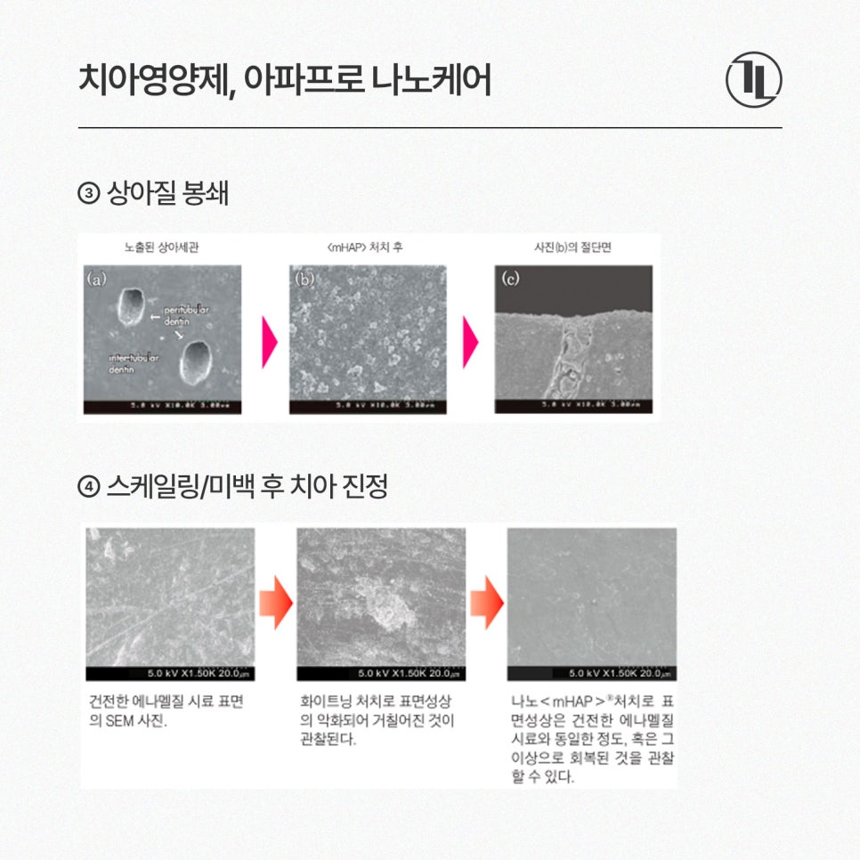 환절기 치아 시림, 아파프로 나노케어로 민감성 치아 관리하기 / 강남레옹치과 관련 이미지 5