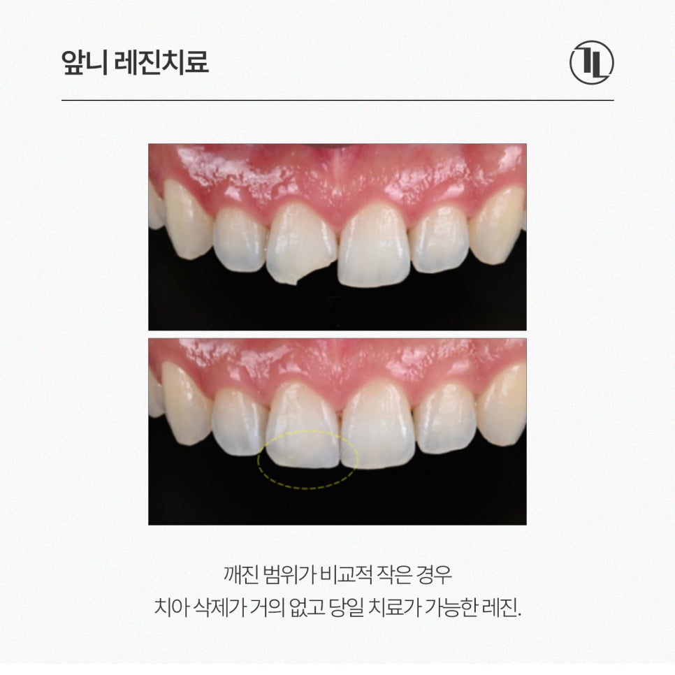 앞니가 깨졌다면?! 4가지 치료방법 비교! / 레진을 선택한 이유 / 강남레옹치과 관련 이미지 4