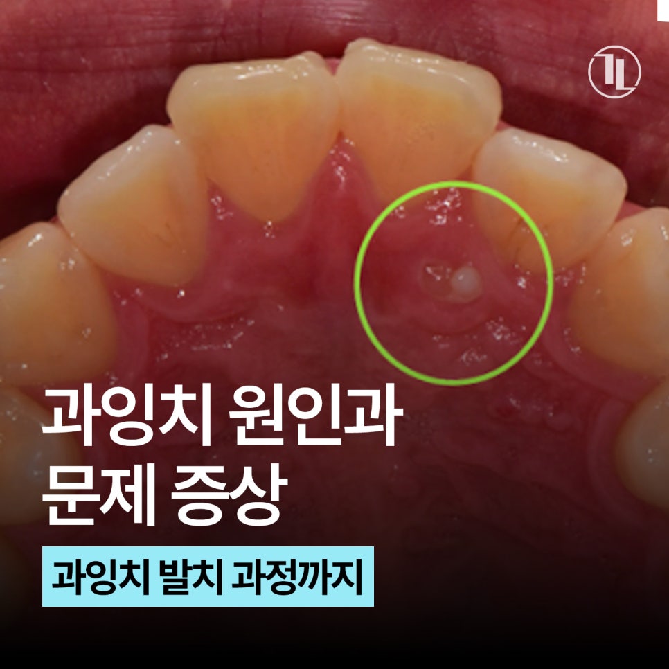 과잉치 원인부터 발치까지 / 과잉치 발치 과정 / 강남레옹치과 관련 이미지 1