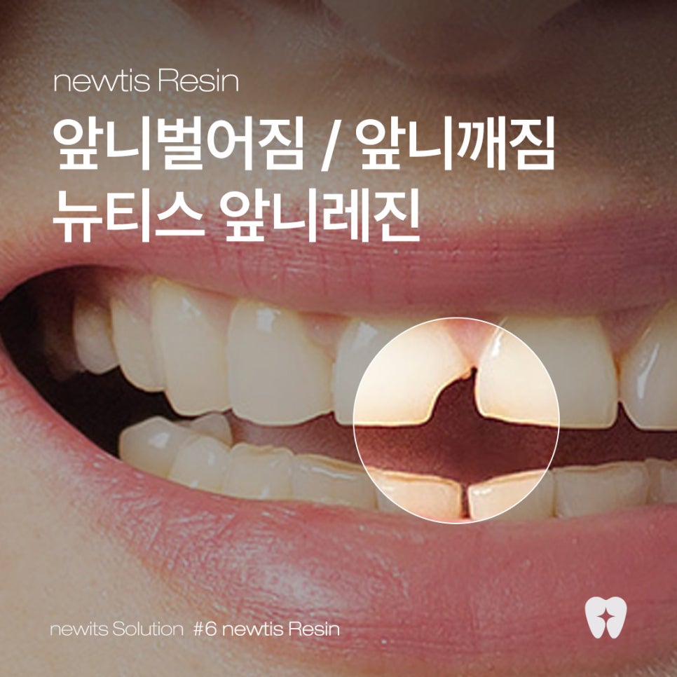 뉴티스 앞니레진✨ 간단하고 자연스럽게 앞니 문제 해결 / 강남레옹치과 관련 이미지 1