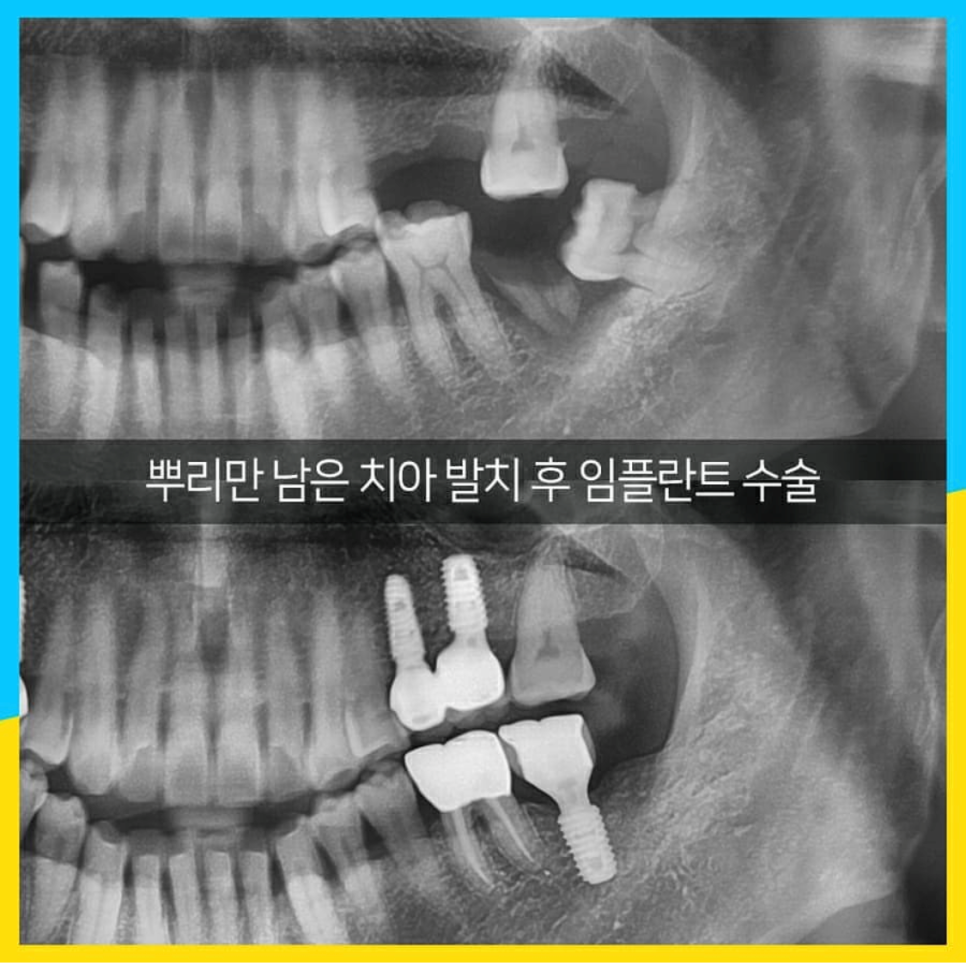 오래 방치했던 치아들 결국 임플란트 수술 관련 이미지 3