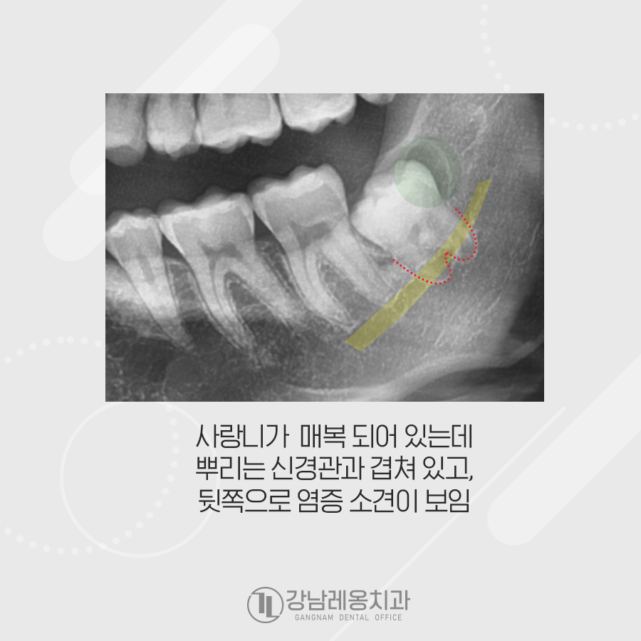 매복 사랑니 뿌리 신경이랑 겹쳐있고 염증까지? 관련 이미지 2
