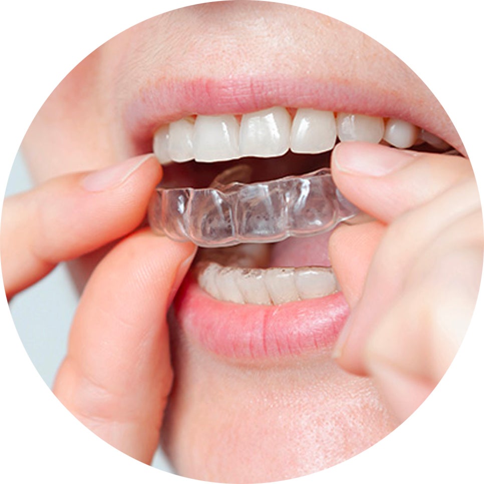 치아교정 종류와 선택법 & 관리 꿀팁 5가지!🖐️ / 강남레옹치과 관련 이미지 3