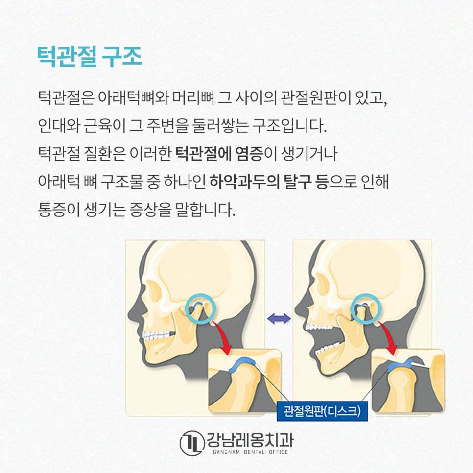 턱관절 질환 초기 증상 5가지로 알아보는 턱관절 통증 원인과 치료 / 강남레옹치과 관련 이미지 2