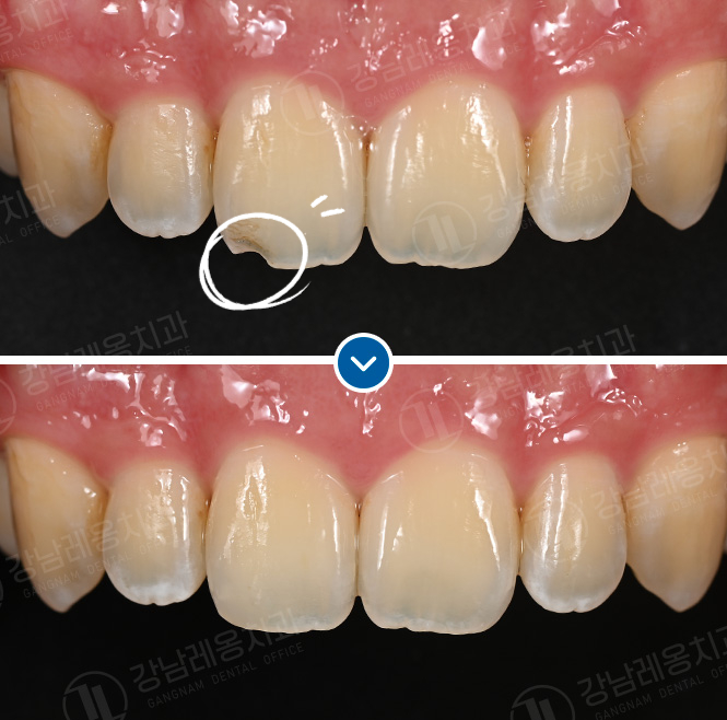 뉴티스 앞니레진✨ 간단하고 자연스럽게 앞니 문제 해결 / 강남레옹치과 관련 이미지 2