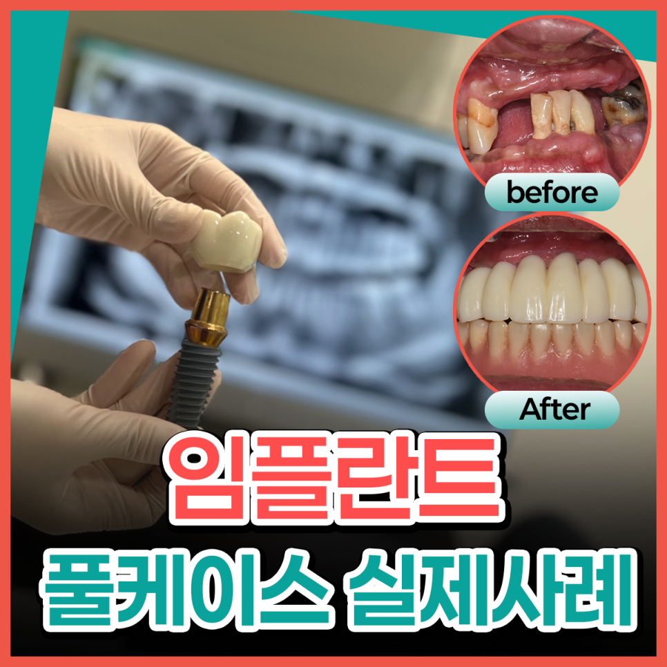 Full-Mouth Implant Treatment Case for Extensive Tooth Loss / Gangnam Leon Dental Clinic image 16