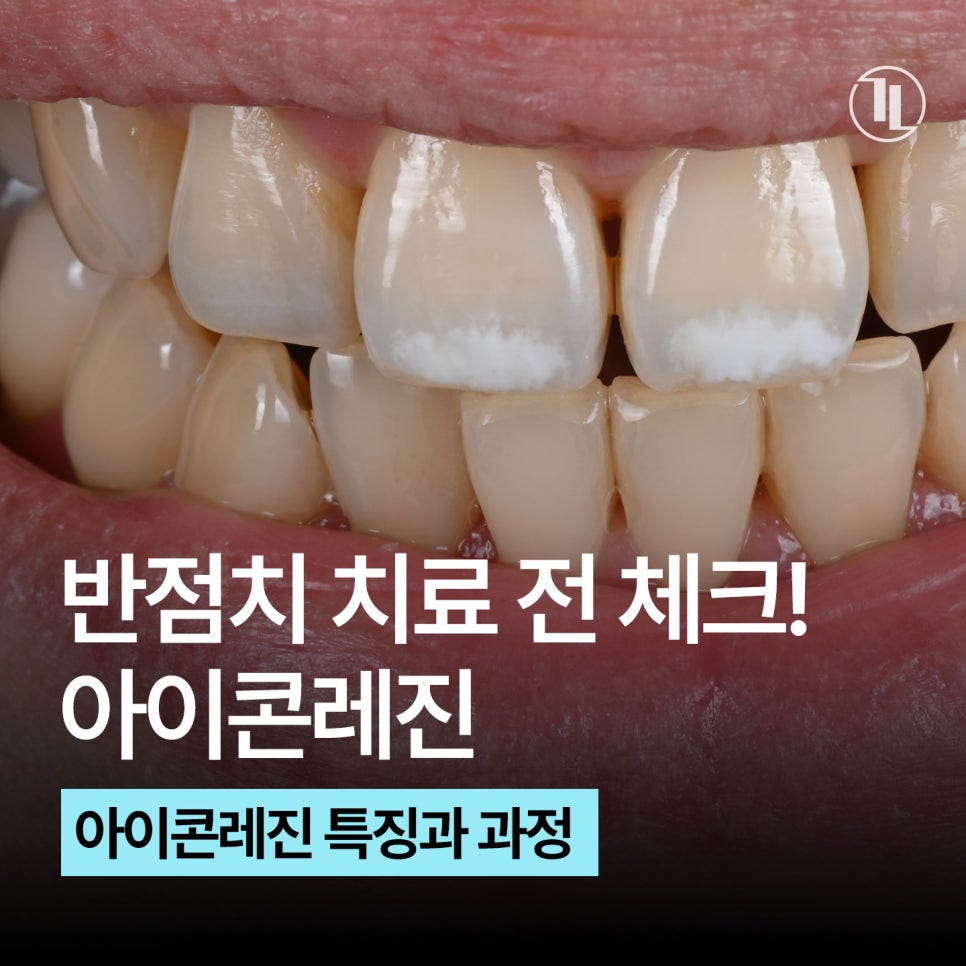 Must Check Before Treating White Spots / Icon Resin Features, Process, and Precautions / Gangnam Leen Dental Clinic image 1