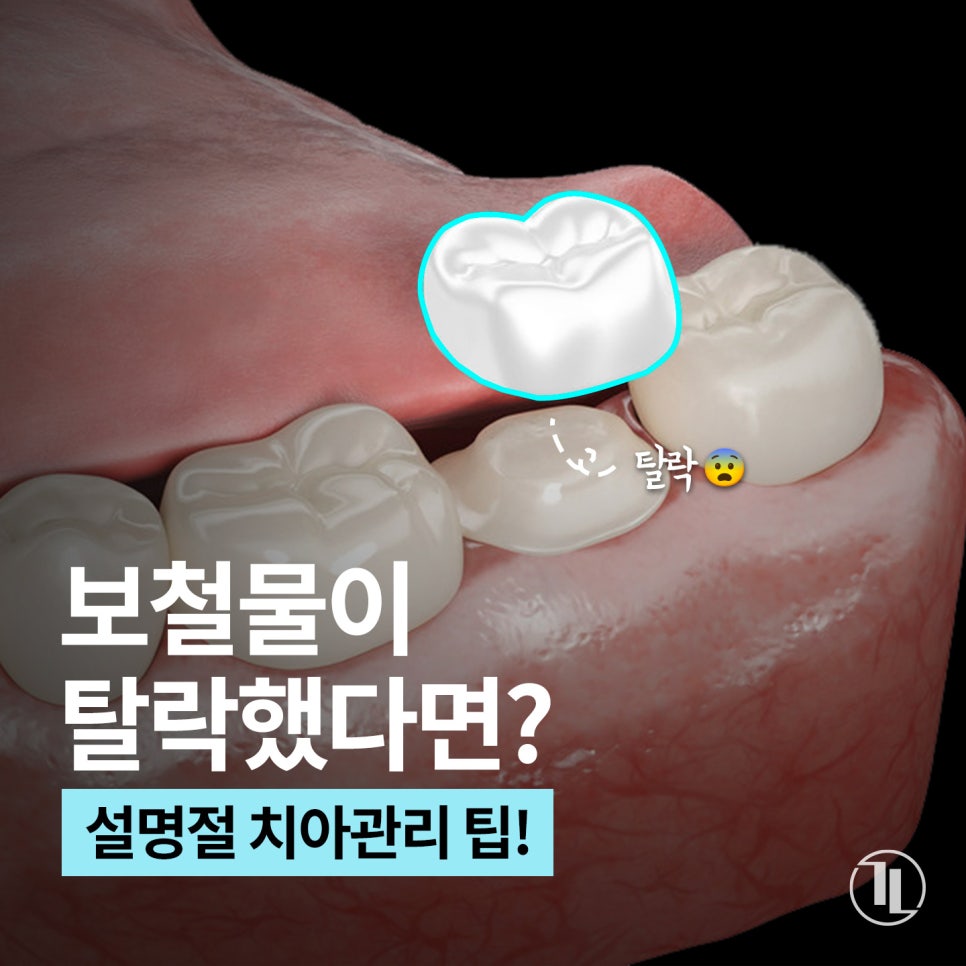 설명절 연휴 보철물이 떨어졌다? 연휴 치아관리 팁!🔖 / 임시공휴일 정상진료 강남레옹치과 관련 이미지 1