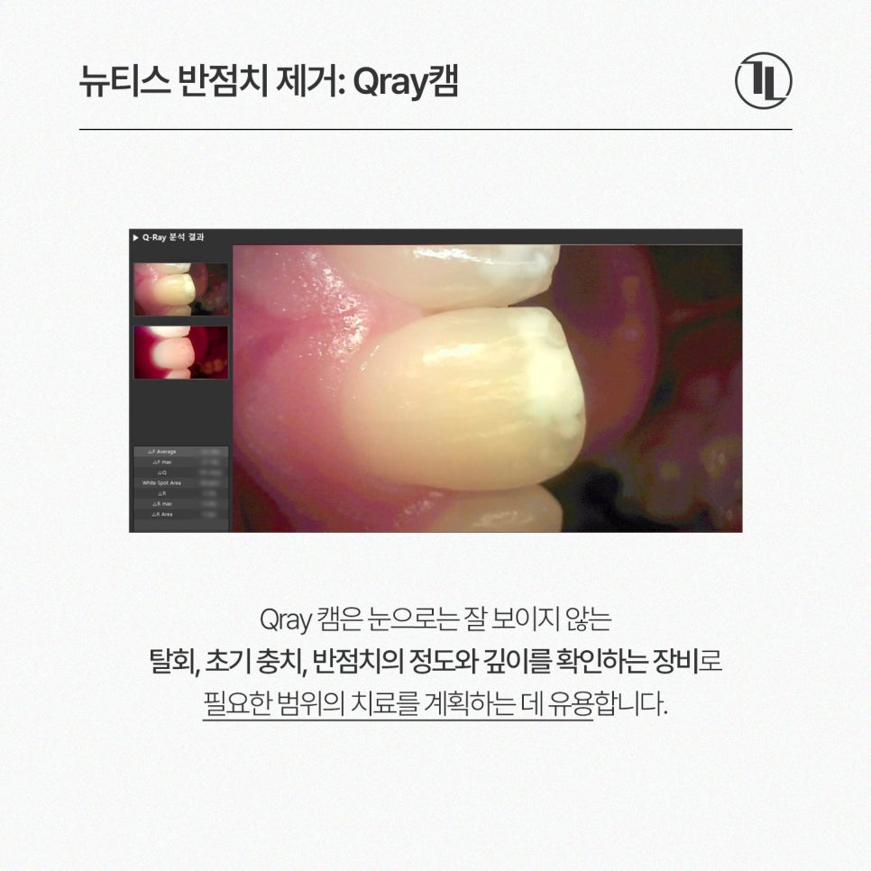 길이가 고르지 않은 반점치, 뉴티스 솔루션 / 아이콘레진 국내 사용량 1위 치과 관련 이미지 3