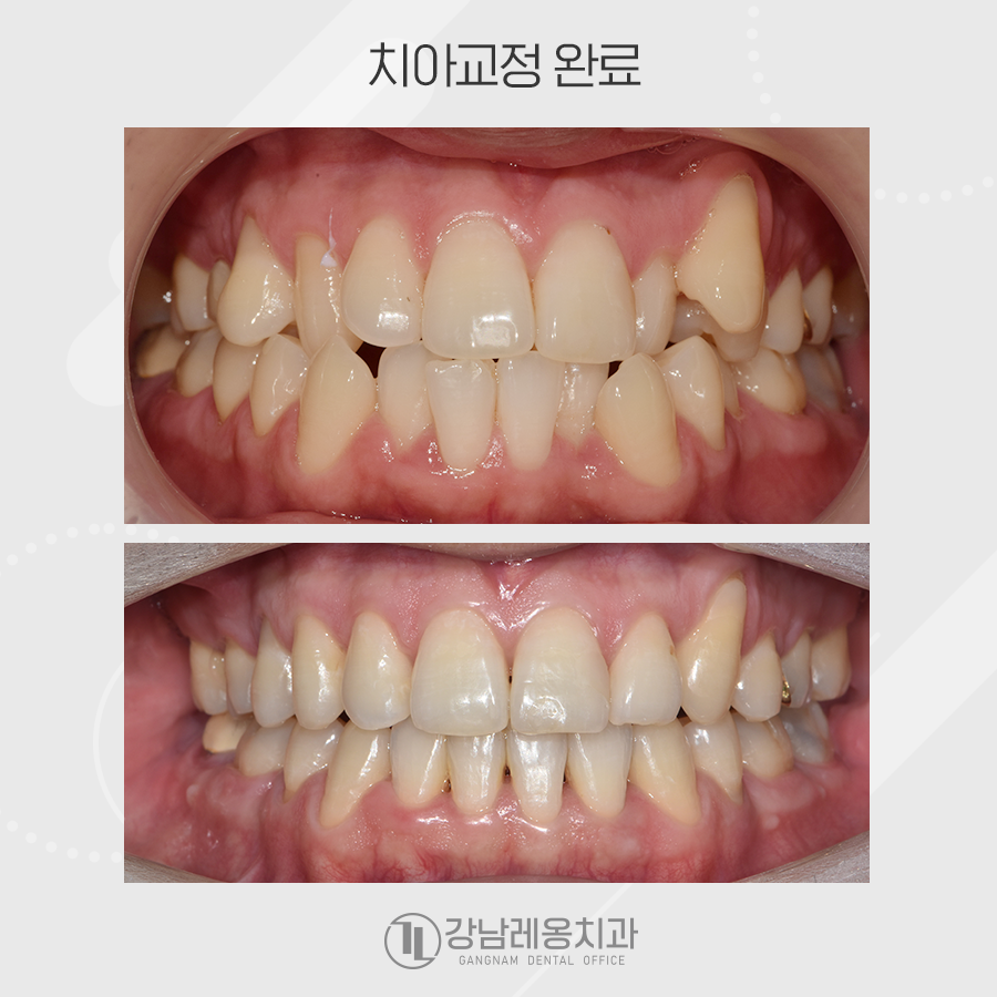 발치 치아교정, 덧니 총생 반대교합까지 한번에 해결 관련 이미지 6