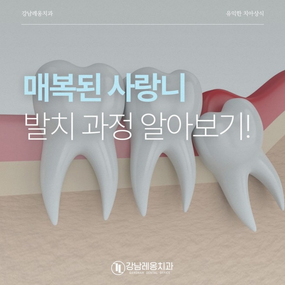 강남레옹치과에서 알려드리는  매복된 사랑니 발치과정에 대해 알아보기! 관련 이미지 1
