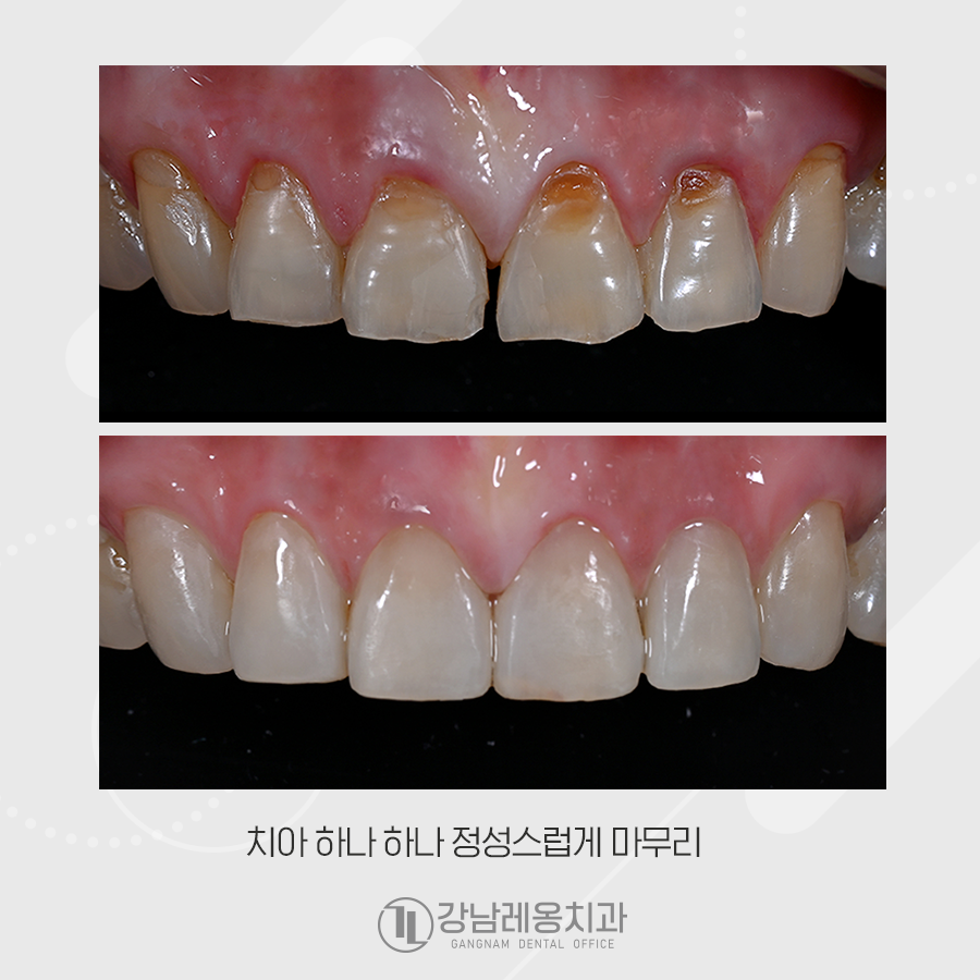 치경부마모증 때문에 시린이 레진 후 라미네이트 관련 이미지 3