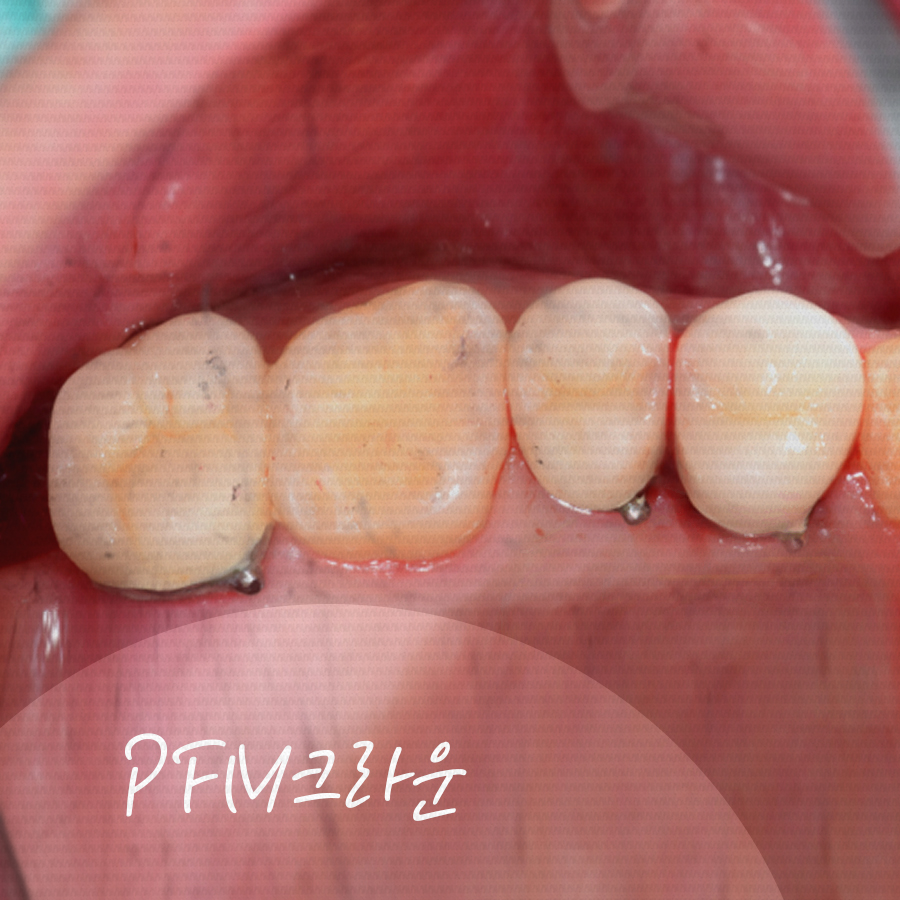 크라운치료 비용, 각자 특징과 장단점이 달라요. 관련 이미지 3
