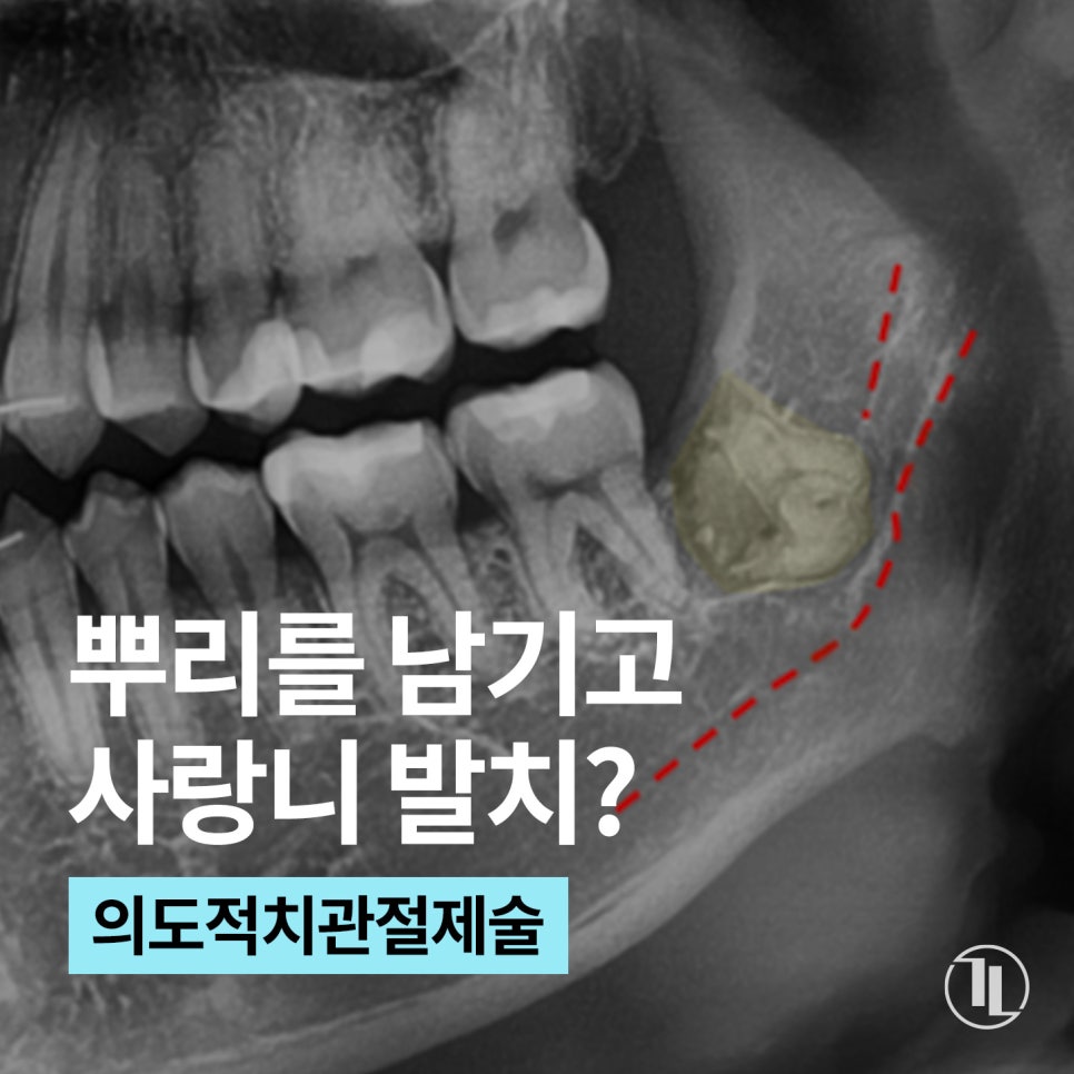 뿌리를 남긴 사랑니 발치? / 강남역 사랑니발치 강남레옹치과 관련 이미지 1