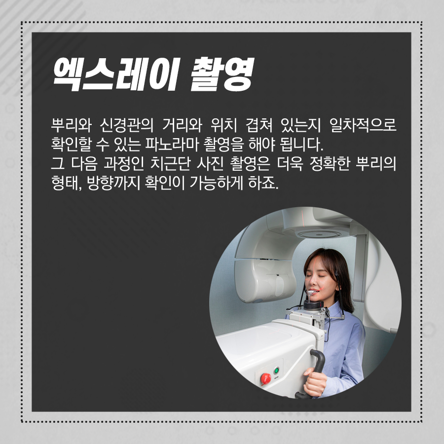 누운 사랑니 발치 과정, 매복 된 상태라면 검사 후 이런 순서로 뽑아요 관련 이미지 3