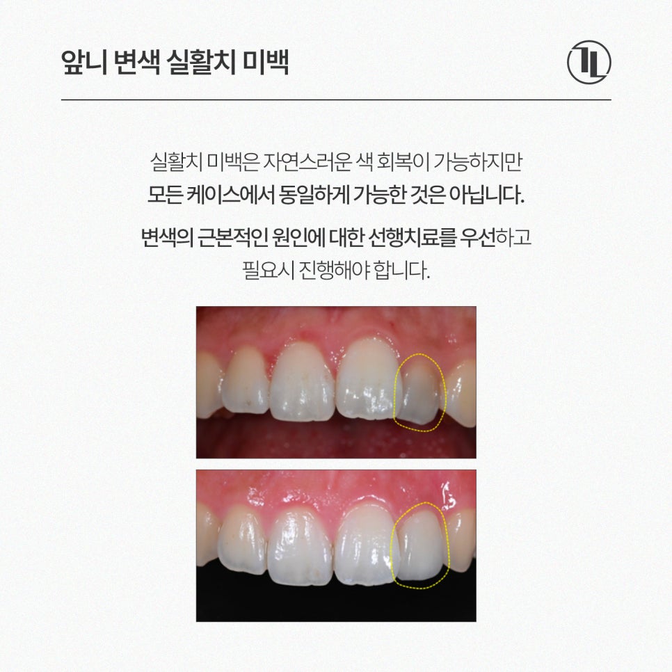 앞니 하나가 어두워졌다? / 앞니 변색 원인과 실활치 미백 과정 / 강남레옹치과 관련 이미지 5