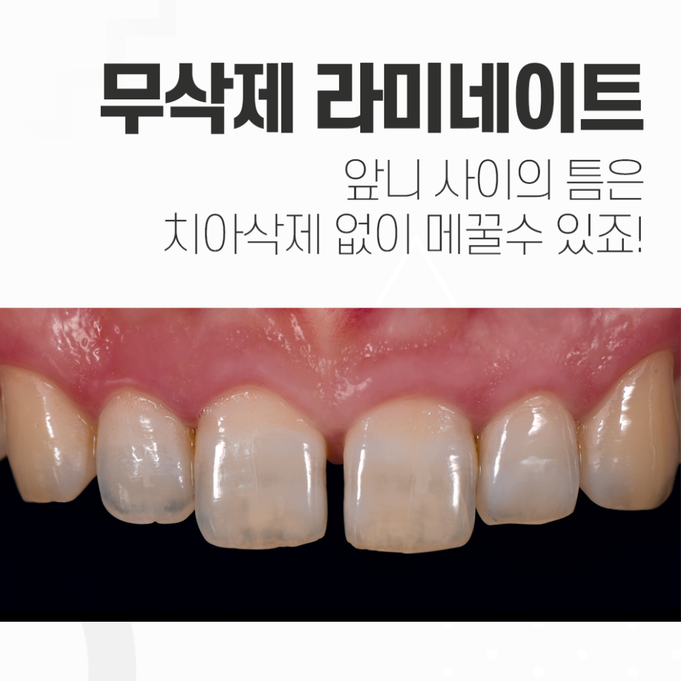 앞니 벌어짐 무삭제 라미네이트 치료는 장단점 꼭 확인! 관련 이미지 4