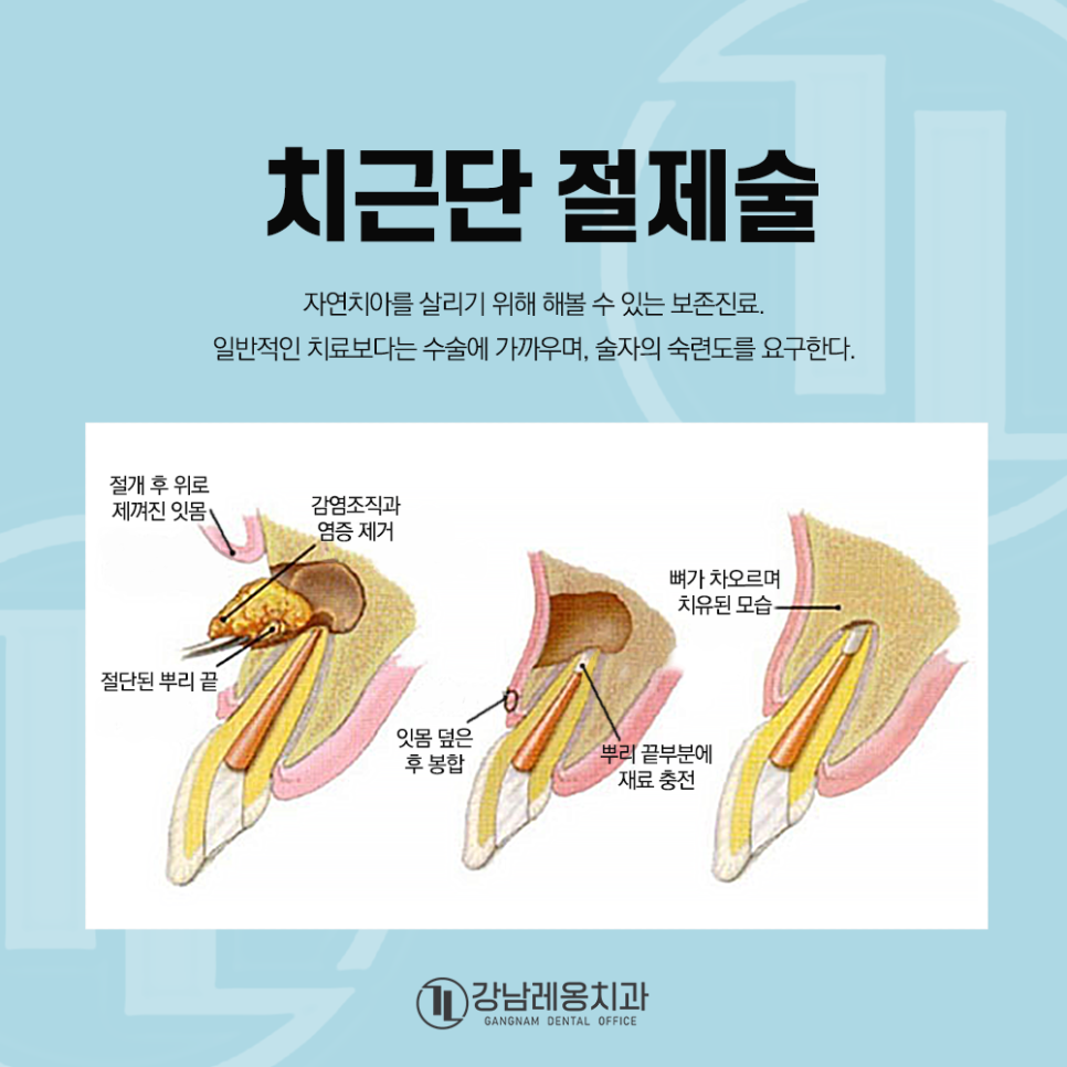 치근단 절제술! 강남레옹치과 자연치아 살리기 최후의 수단 (Part 1) 관련 이미지 2