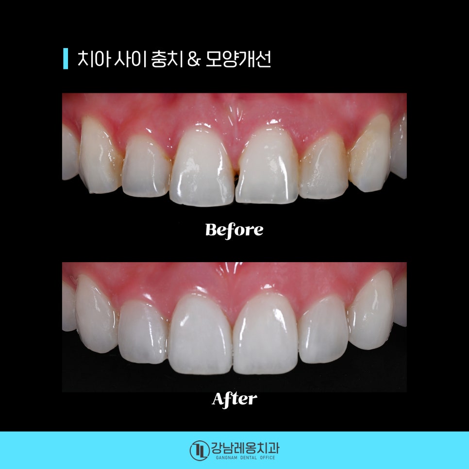 최소삭제 라미네이트 &lsquo;뉴티스&rsquo;의 시술 후 관리방법은? / 양치질, 치실 사용방법 / 강남레옹치과 관련 이미지 4