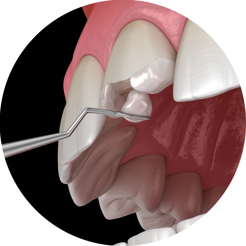 앞니 벌어짐 치료 후기 / 아이 앞니 벌어짐 건강하게 치료하려면? / 강남레옹치과 관련 이미지 8