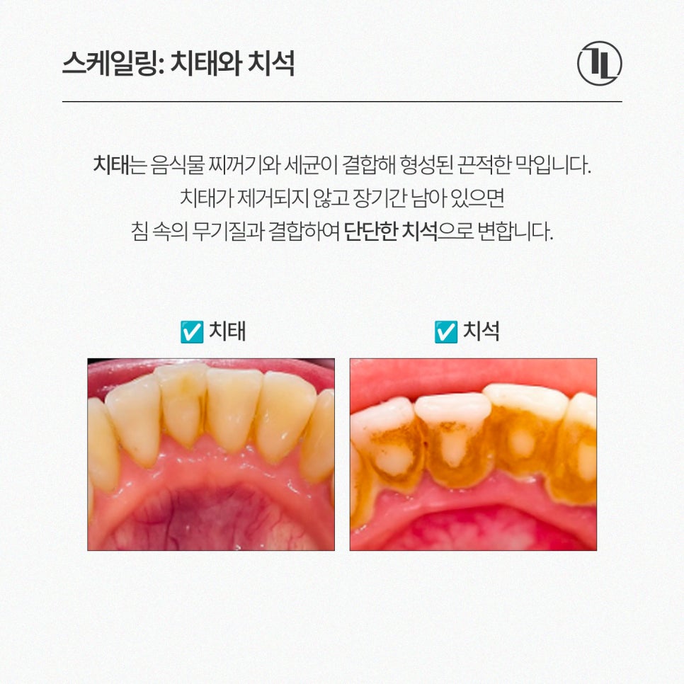 2026 스케일링 비용 / 스케일링 이 시림, 식사, 자주묻는 질문 총정리 / 강남레옹치과 관련 이미지 2