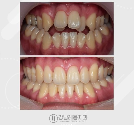 여름방학, 강남레옹치과에서 치아교정 할 타이밍! 관련 이미지 9