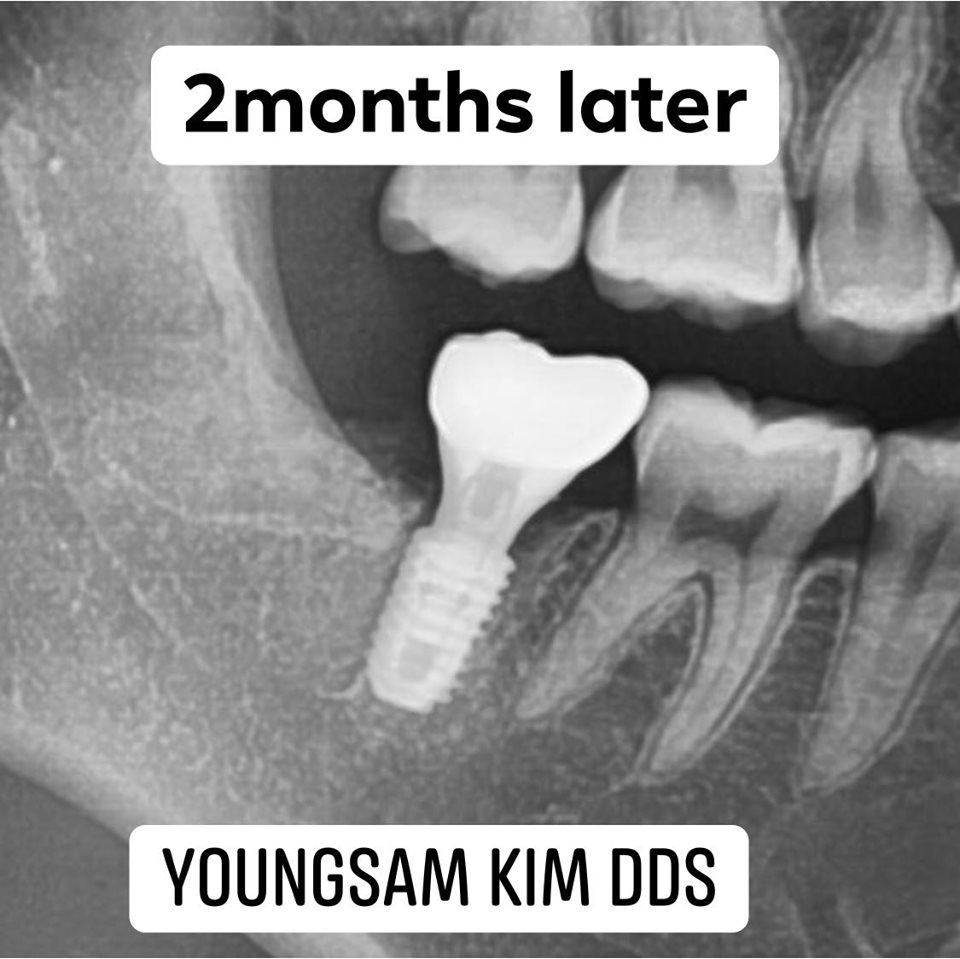 강남레옹치과 원데이 임플란트, 발치 즉시 식립까지 완료 관련 이미지 2