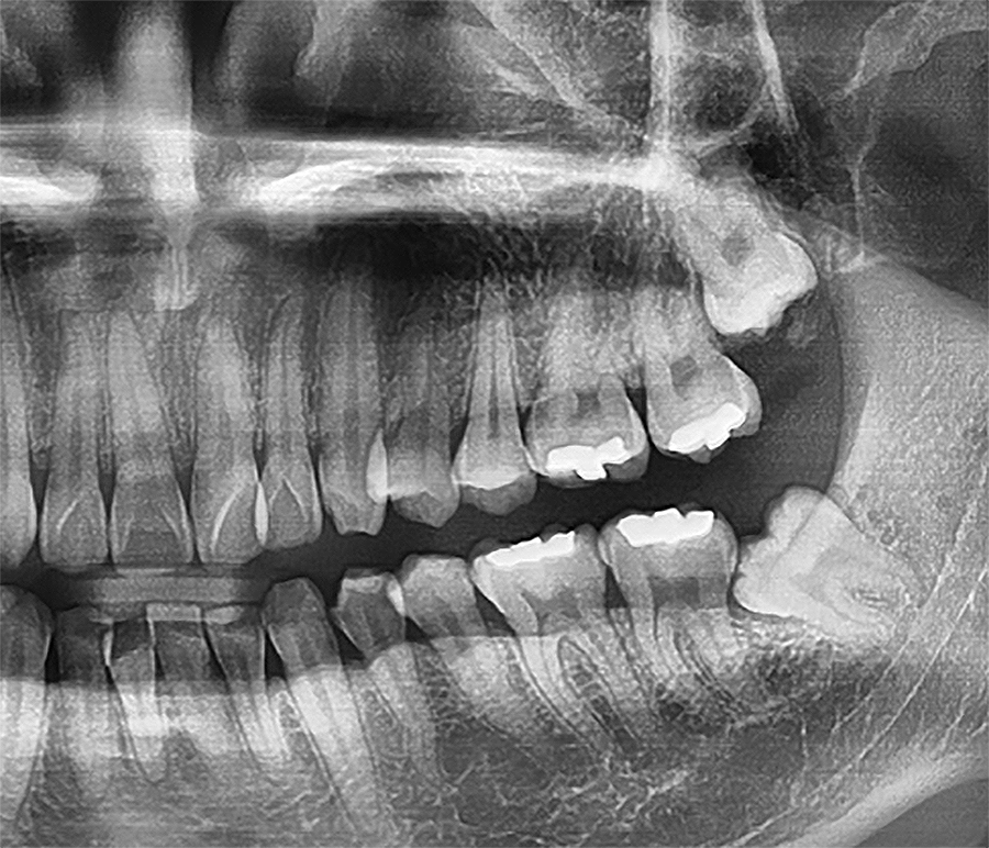 사랑니 당일 발치 가능한 곳, 강남역치과 레옹! 관련 이미지 2
