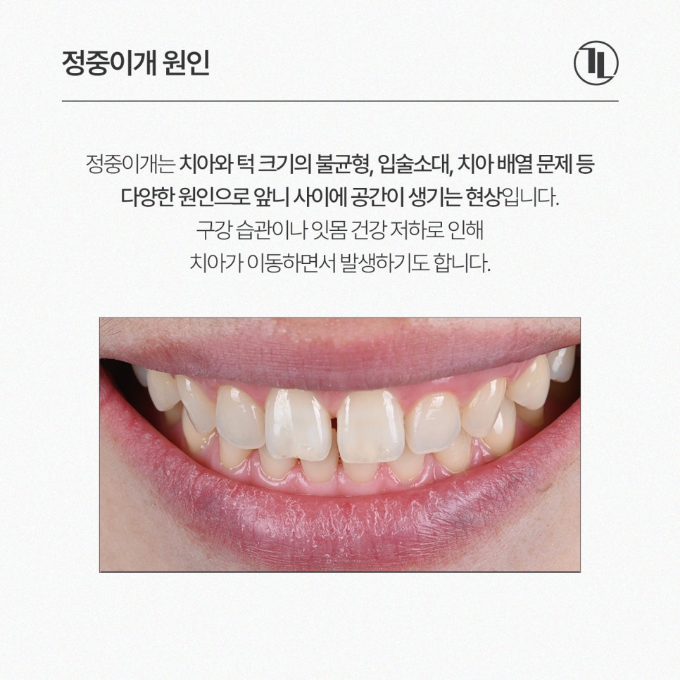 앞니 벌어짐, 정중이개 뉴티스라미 / 강남레옹치과 뉴티스 스마일 시뮬레이션 관련 이미지 2