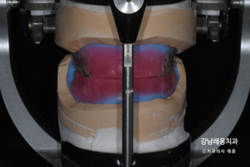 만 65세 이상 틀니 보험적용 혜택과 과정💫 / 보훈위탁병원 강남레옹치과 관련 이미지 5