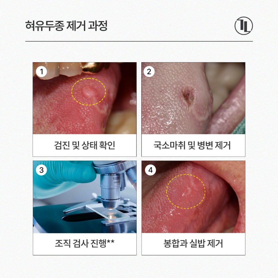 Small Bump (Growth) on the Tongue: Symptoms and Causes of Tongue Papilloma, and the Removal Process / Gangnam Leon Dental Clinic image 4