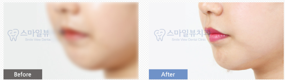 신논현역치과 역교정 관련 이미지 4