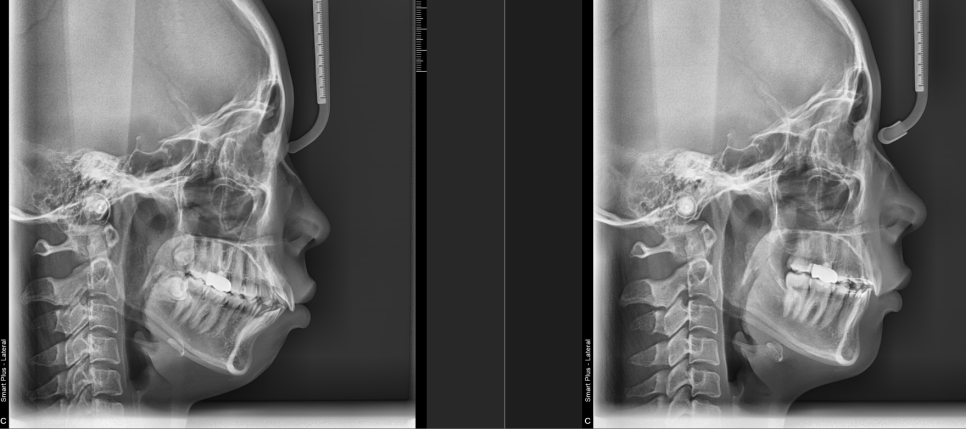 Protrusive Mouth: Do You Have to Have Surgery? Cases That Can Be Treated with Orthodontics image 1
