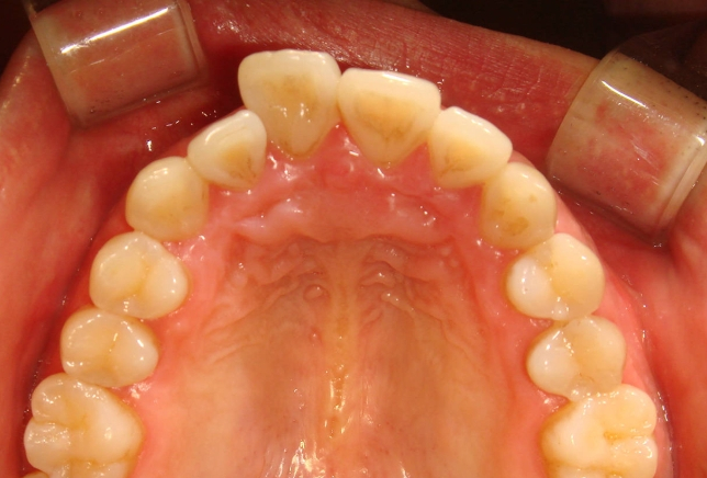 신논현역 치과 설측 부분교정 관련 이미지 7