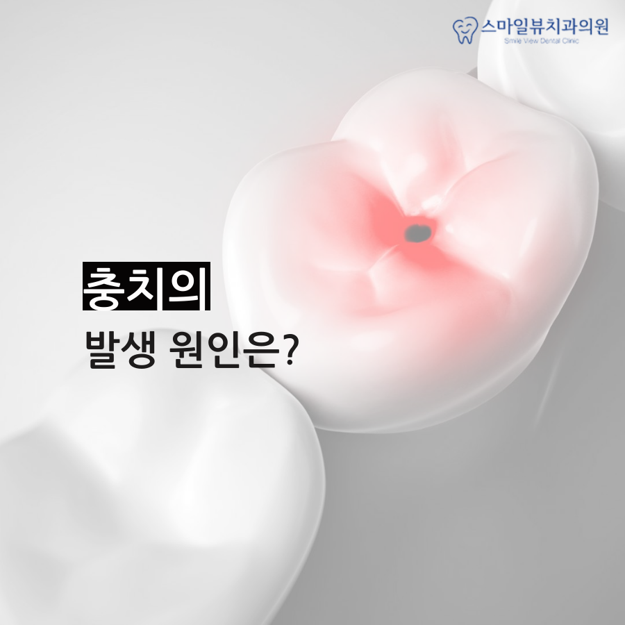 강남치과레진인레이 두 재료의 다른 점은? 관련 이미지 3