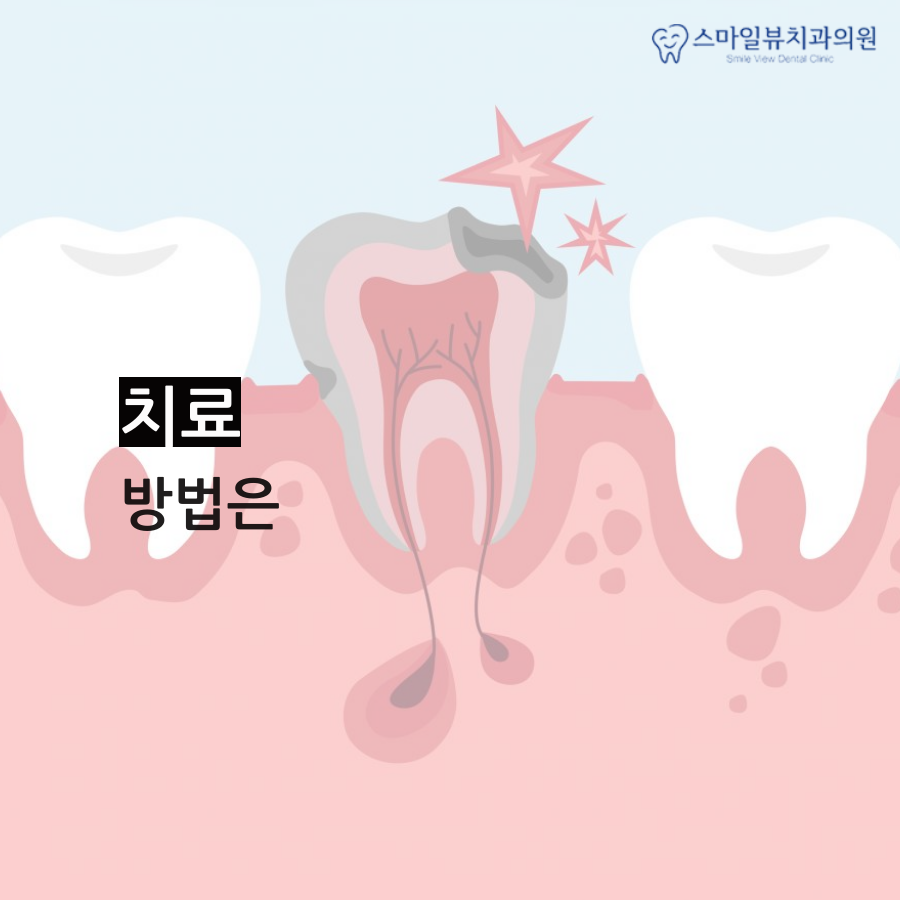역삼역치과추천 치아우식증 진행과정 관련 이미지 3