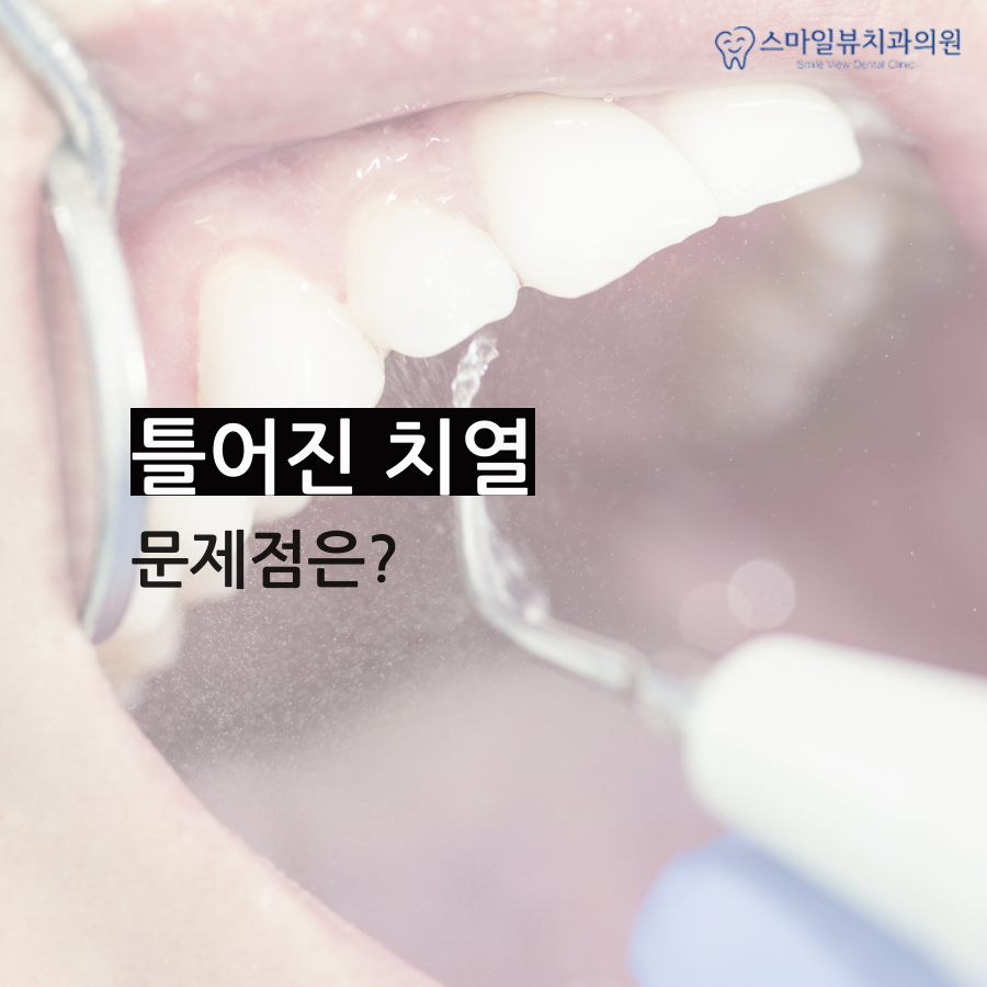 강남돌출입교정 수술 없이 가능해요! 관련 이미지 2